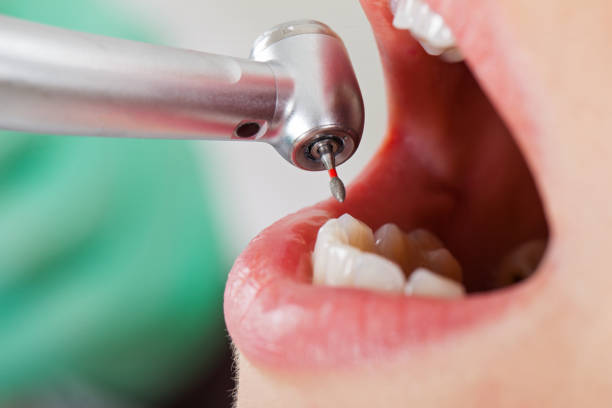 Best Emergency Wisdom Tooth Extraction in Morgantown, MS